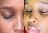 Skin care